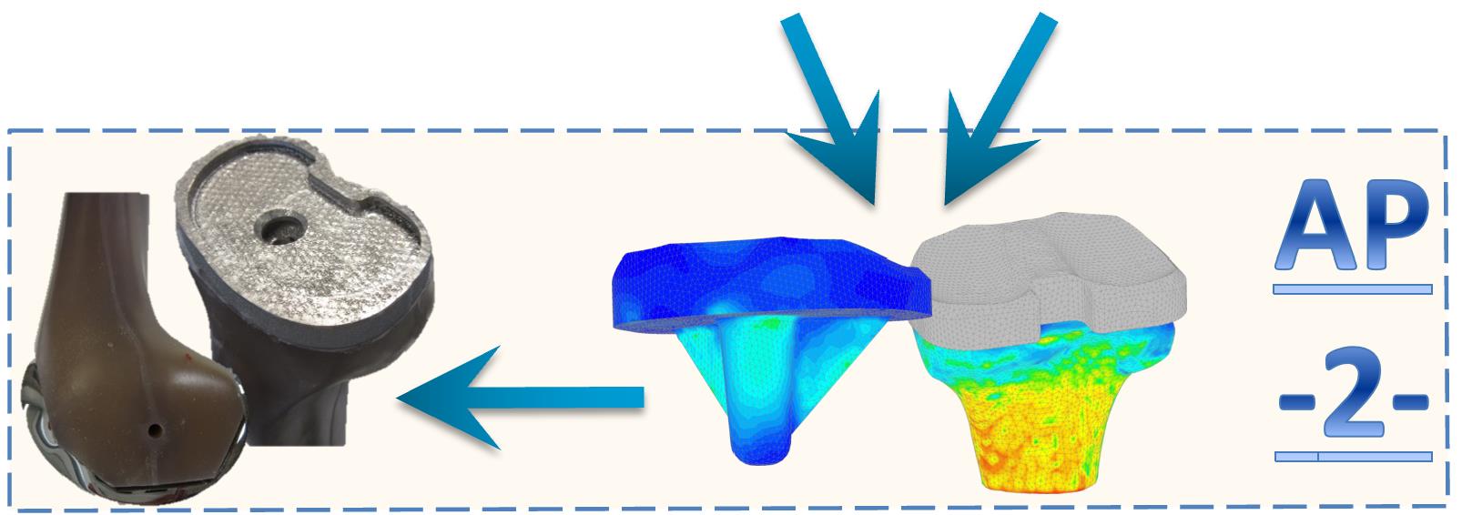 Biomechanische Optimierung und gefertigtes individuelles Knieimplantat