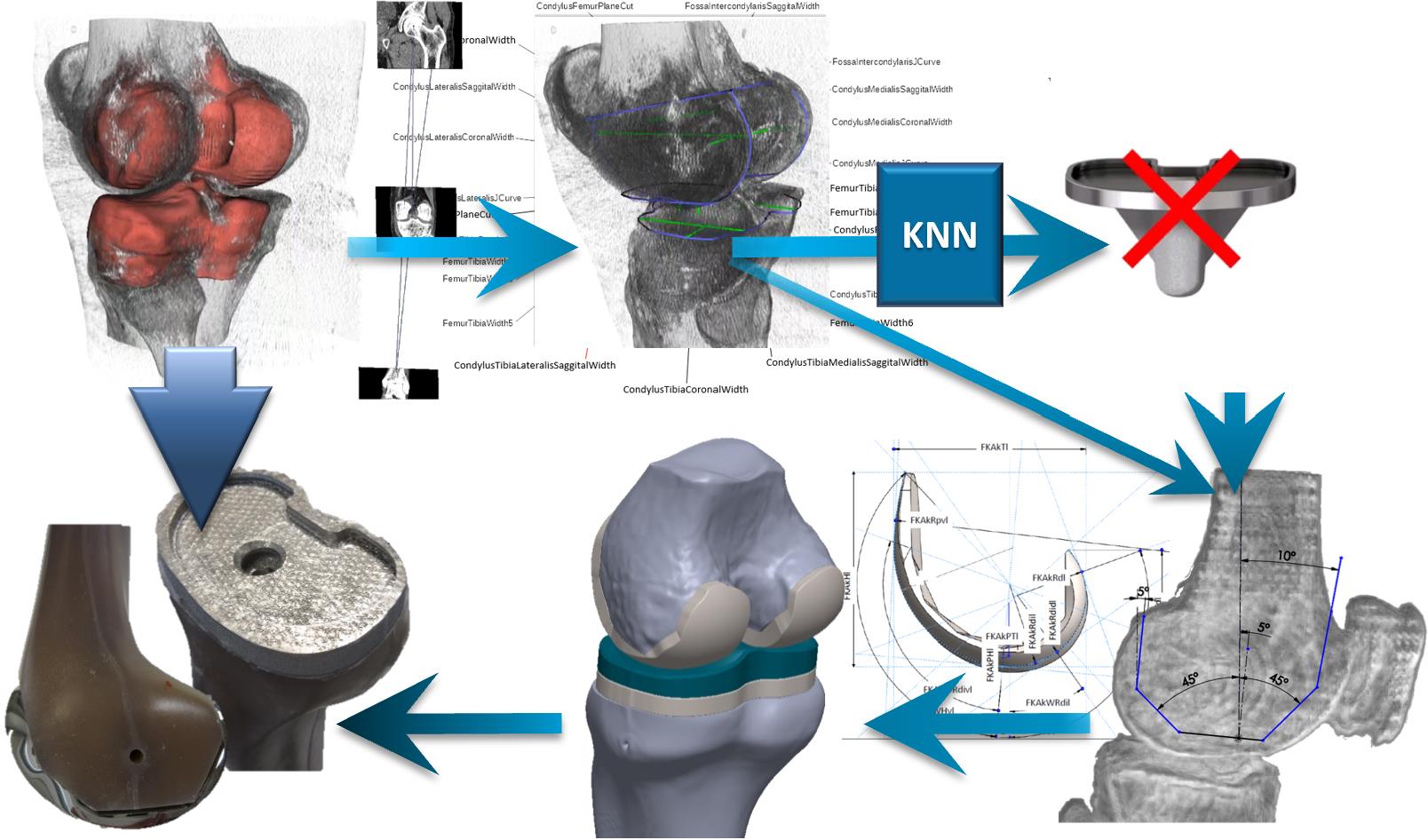 EXPERTEB – Expertensystem für das computergestützte Design individueller Knieimplantate