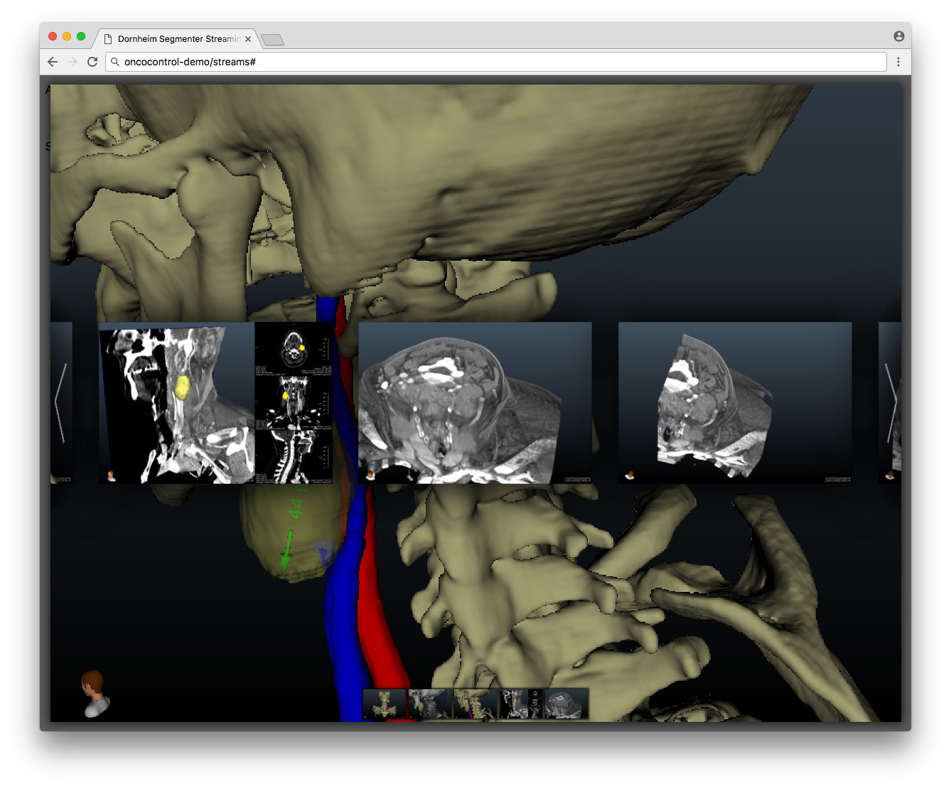 3D-Rekonstruktion des Kopf-Hals-Bereichs mit eingeblendeten CT-Schichten im Webbrowser