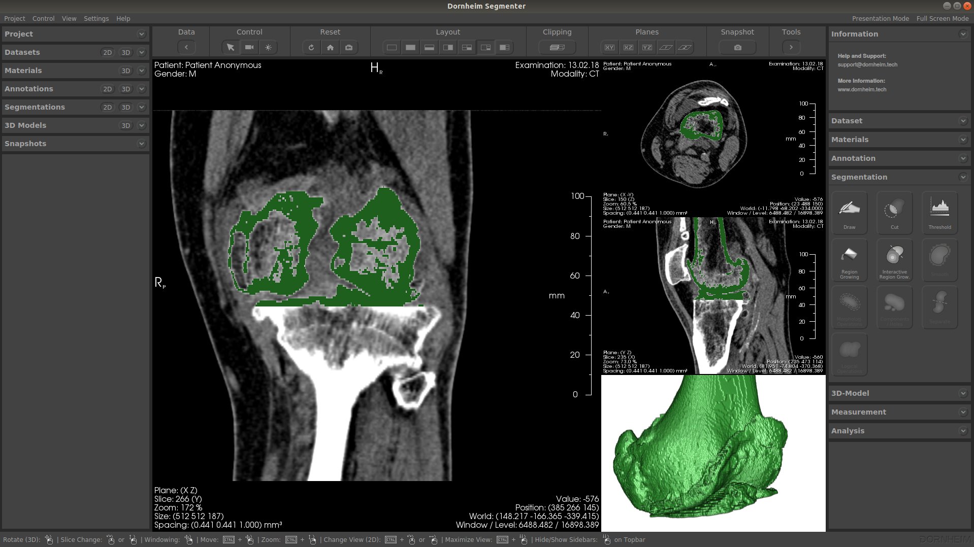 Automatisierte 3D-Segmentierung des Femurknochens am Kniegelenk aus CT-Daten im Dornheim Segmenter